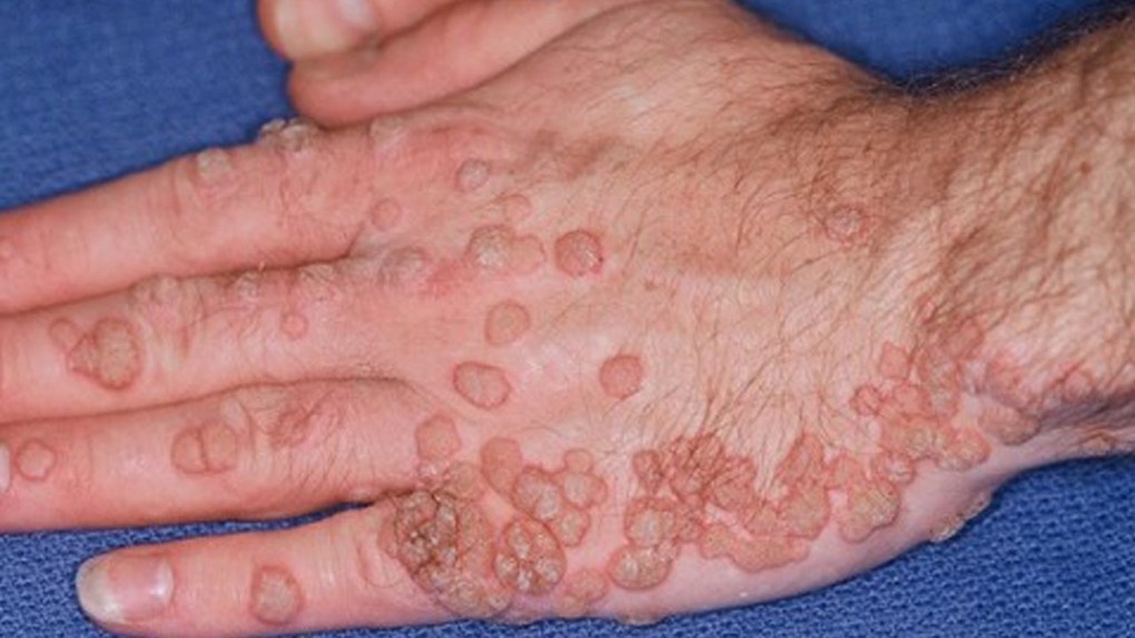 Wart Removal Methods Recommended by Dermatologists  Clinikally