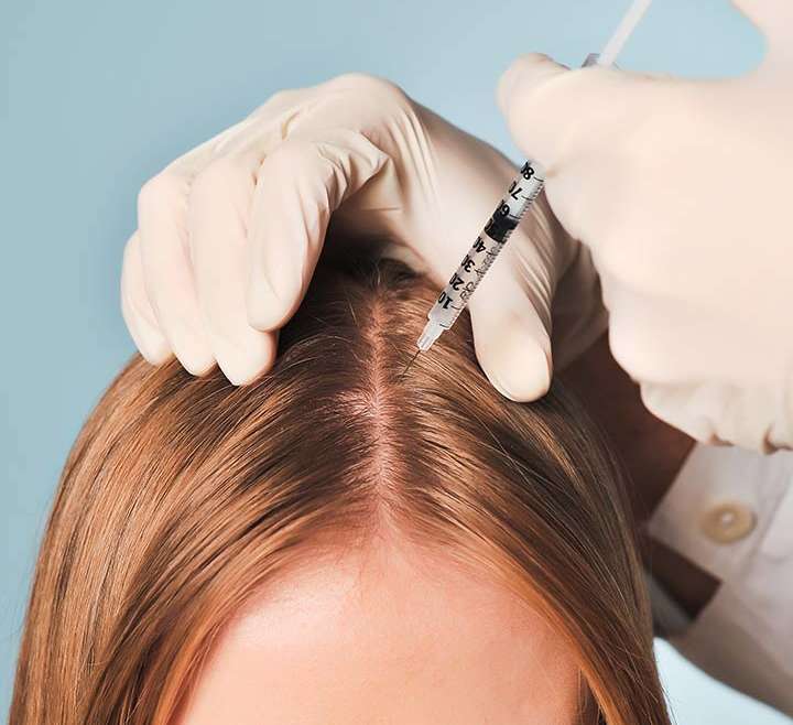 MESO THERAPY (HAIR LOSS SOLUTION)
