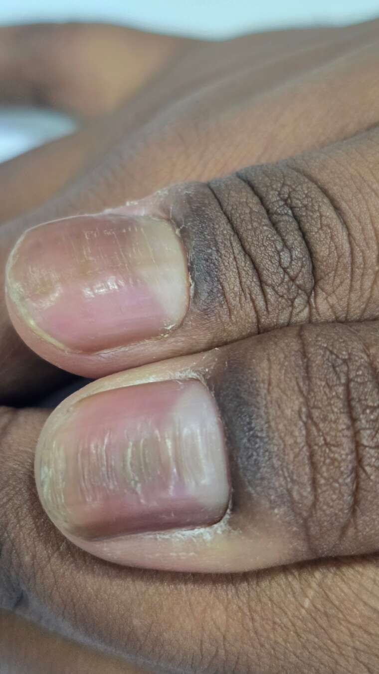 Transverse Ridges In Mails Nail diseases – Heta Skin Hair Laser & Cosmetic Clinic In Ahmedabad
